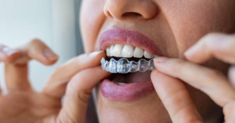 Harmony in Motion: Invisalign's Role in Dynamic Dental Care